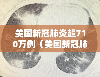 美国新冠肺炎超710万例（美国新冠肺炎超1200万例）