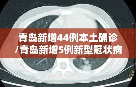 青岛新增44例本土确诊/青岛新增5例新型冠状病毒感染的肺炎确诊病例 青岛新增44例本土确诊/青岛新增5例新型冠状病毒感染的肺炎确诊病例