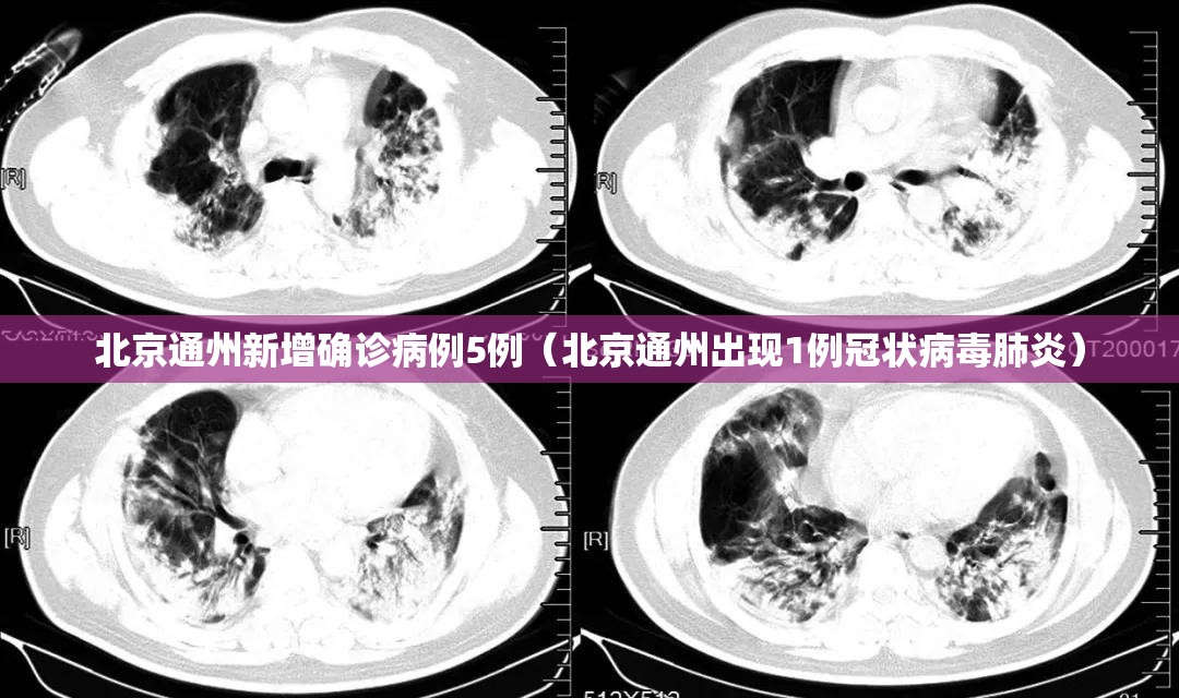 北京通州新增确诊病例5例(北京通州出现1例冠状病毒肺炎) 北京通州新增确诊病例5例(北京通州出现1例冠状病毒肺炎)