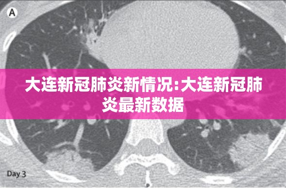 大连新冠肺炎新情况:大连新冠肺炎最新数据 大连新冠肺炎新情况:大连新冠肺炎最新数据