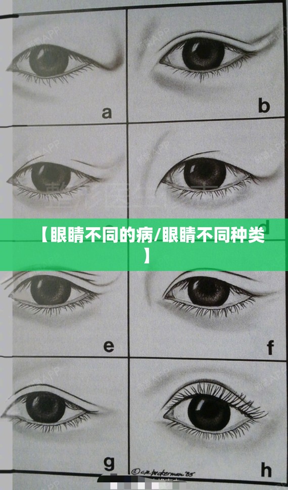 【眼睛不同的病/眼睛不同种类】