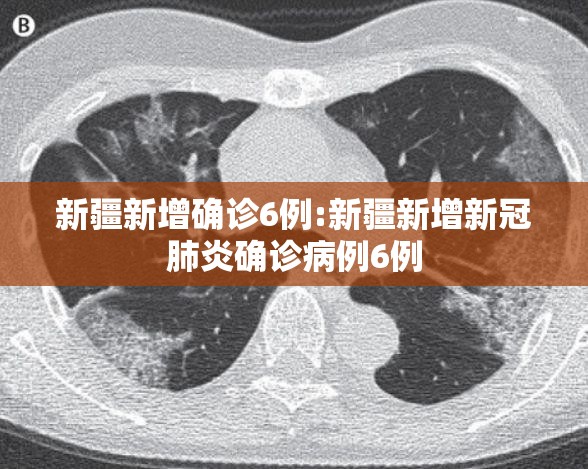 新疆新增确诊6例:新疆新增新冠肺炎确诊病例6例