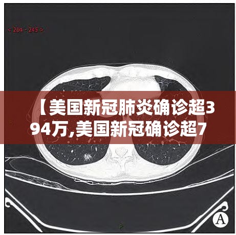 【美国新冠肺炎确诊超394万,美国新冠确诊超737万】 【美国新冠肺炎确诊超394万,美国新冠确诊超737万】