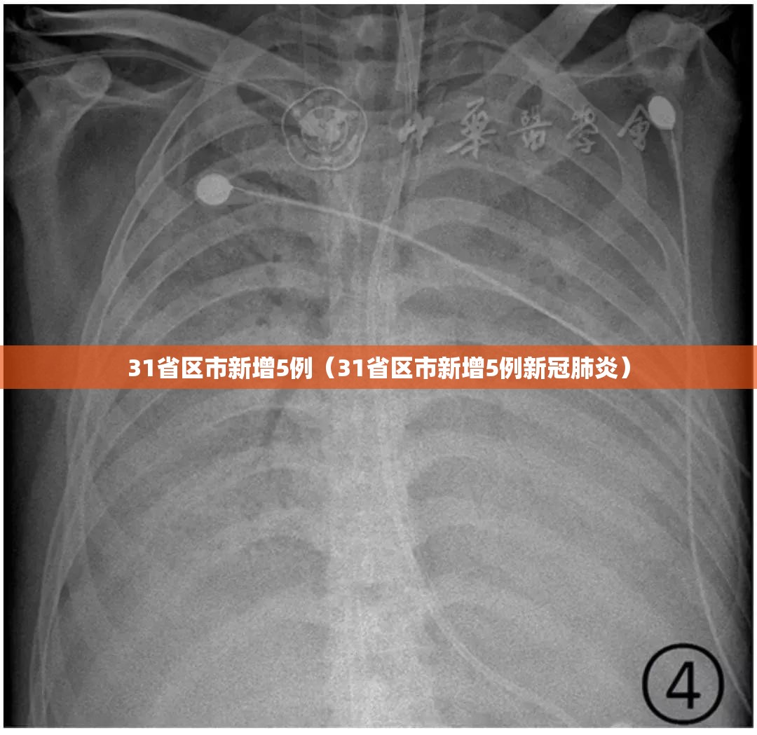 31省区市新增5例(31省区市新增5例新冠肺炎) 31省区市新增5例(31省区市新增5例新冠肺炎)