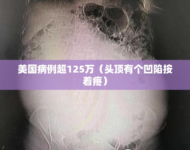 美国病例超125万（头顶有个凹陷按着疼）