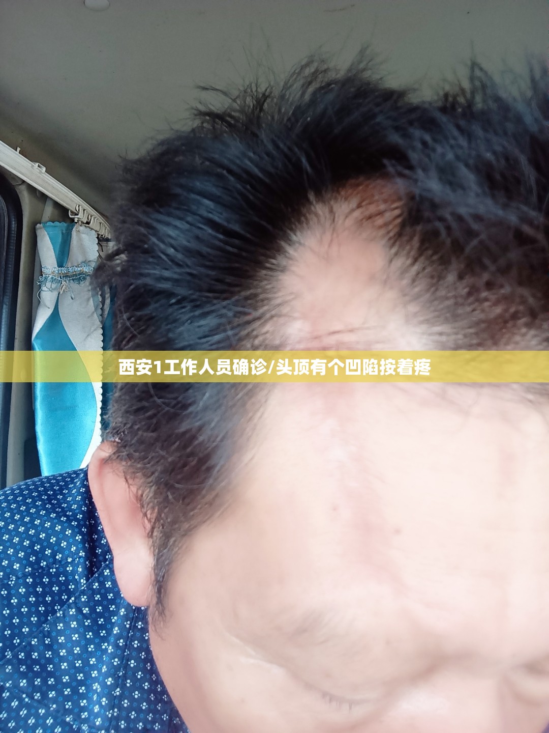 西安1工作人员确诊/头顶有个凹陷按着疼 西安1工作人员确诊/头顶有个凹陷按着疼